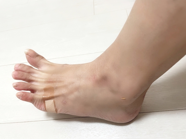 足の小指の変形「内反小趾」-原因と対策方法をお伝えします